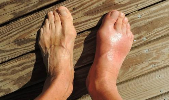 9 Makanan Penyebab Asam Urat Tinggi