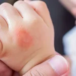 Cara Mengatasi Eksim Secara Alami: Apa yang Harus Dihindari