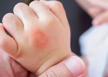 Cara Mengatasi Eksim Secara Alami: Apa yang Harus Dihindari