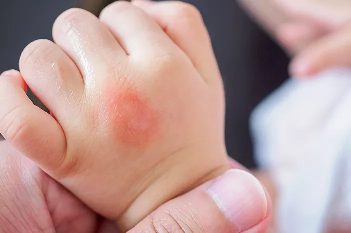 Cara Mengatasi Eksim Secara Alami: Apa yang Harus Dihindari