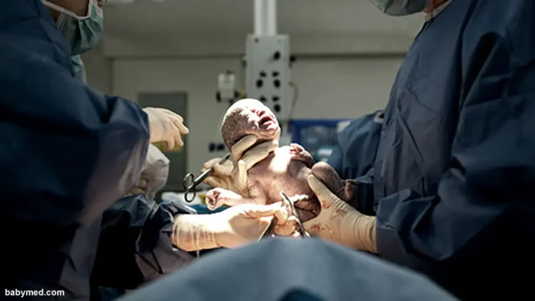 Syarat dan Cara Operasi Caesar Menggunakan BPJS