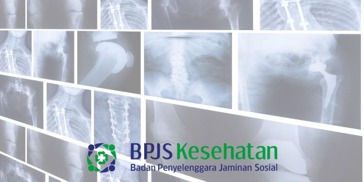 Apakah Rontgen Bisa Pakai BPJS? Simak Penjelasannya di Sini!