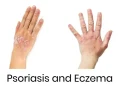 Psoriasis vs Eksim: Kenali Bedanya agar Tak Salah Obat!