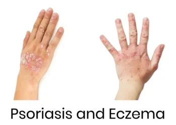 Psoriasis vs Eksim: Kenali Bedanya agar Tak Salah Obat!