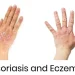 Psoriasis vs Eksim: Kenali Bedanya agar Tak Salah Obat!