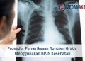 Prosedur Pemeriksaan Rontgen Gratis Menggunakan BPJS Kesehatan