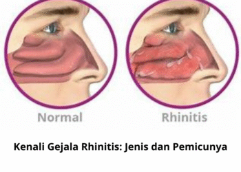 Kenali Gejala Rhinitis: Jenis dan Pemicunya