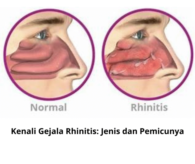 Kenali Gejala Rhinitis: Jenis dan Pemicunya