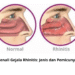 Kenali Gejala Rhinitis: Jenis dan Pemicunya