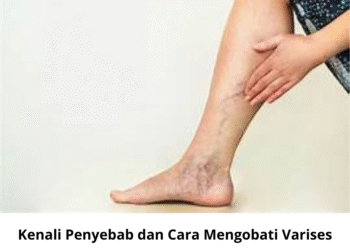 Kenali Penyebab dan Cara Mengobati Varises