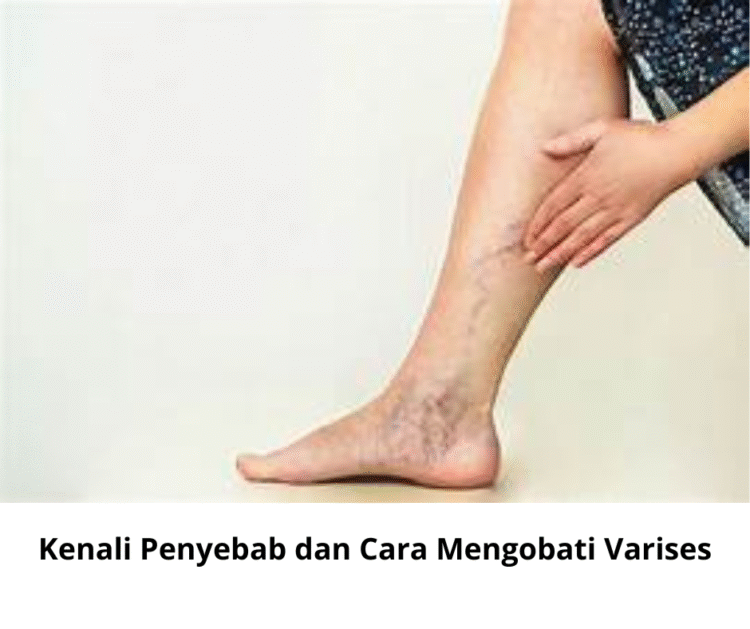 Kenali Penyebab dan Cara Mengobati Varises