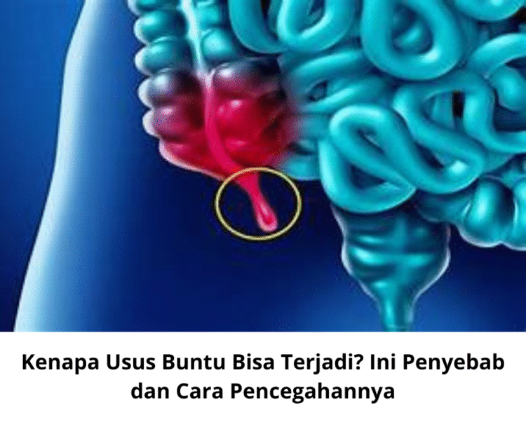 Kenapa Usus Buntu Bisa Terjadi? Ini Penyebab dan Cara Pencegahannya