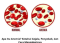 Apa Itu Anemia? Ketahui Gejala, Penyebab, dan Cara Mengobatinya