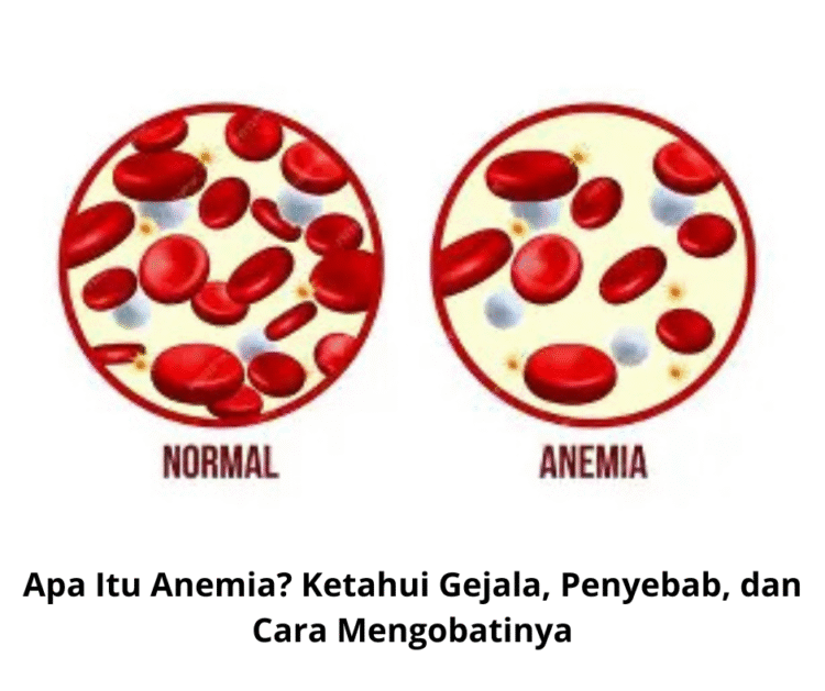 Apa Itu Anemia? Ketahui Gejala, Penyebab, dan Cara Mengobatinya