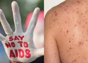 Waspada! Inilah Ciri-Ciri HIV Pada Kulit Yang Dapat Kamu Ketahui