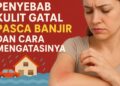 Penyebab Kulit Gatal Pasca Banjir dan Cara Mengatasinya